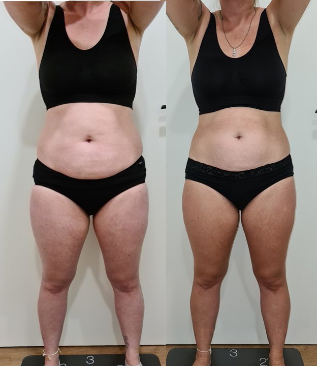 Avant / apres cryolipolyse femme sous vetement noir